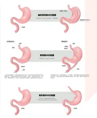 “袖胃”减肥魔法背后1