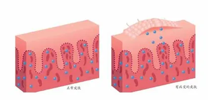 带状疱疹急性期，5类药不能少