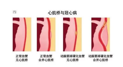 貌似冠心病实则心肌桥1