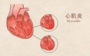 感染新冠病毒会诱发心肌炎吗0
