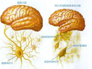 阿尔茨海默病：谁是元凶？3