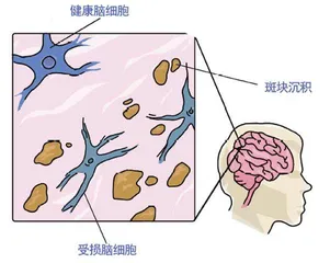 阻断T细胞1