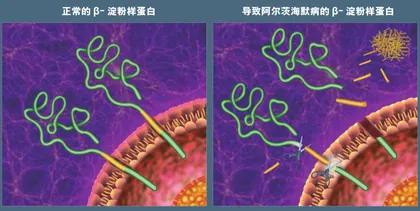 阿尔茨海默病新药上市背后的重重挑战0