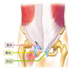 腹股沟疝会自愈吗