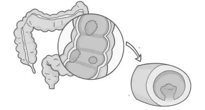 结肠息肉：早期发现与预防