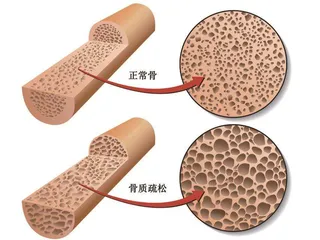 打造坚固骨质，远离脆弱风险0