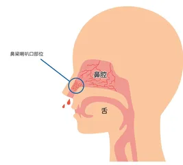 鼻出血一定是秋燥冬上火？别不当回事儿1